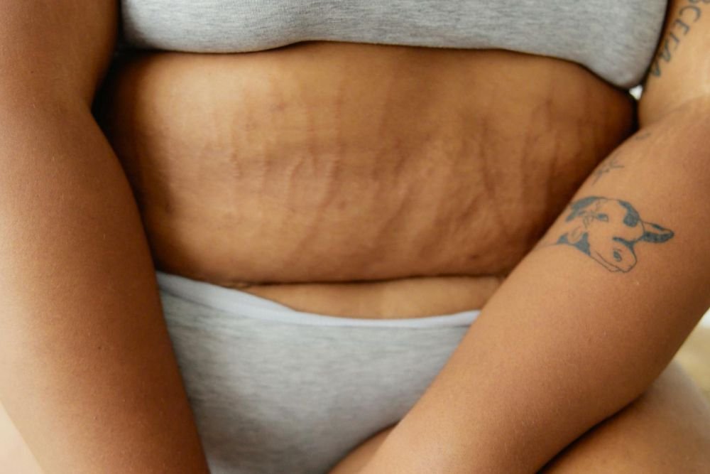 Say Goodbye to Bump on Stretch Mark – Embrace Healthy Skin with Lifestyle Changes