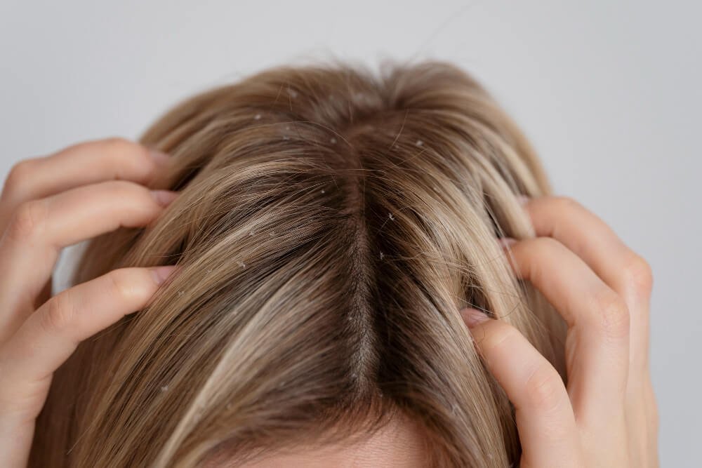 How to Eliminate Dandruff Without Damaging Your Hair Follicles